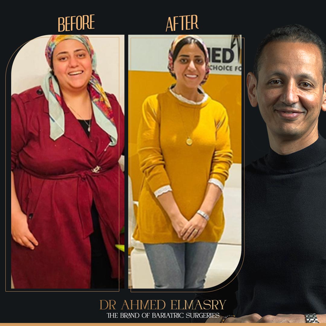 قصة نجاح تكميم المعدة 